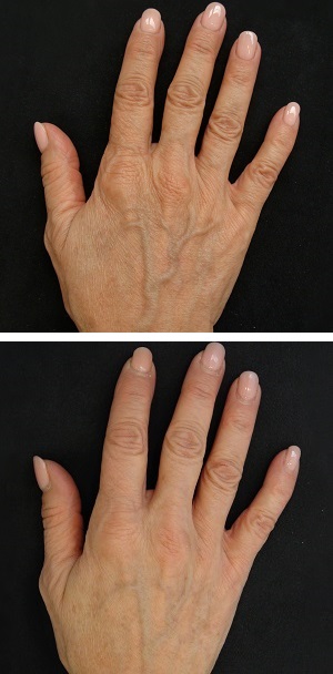 dłoń przed i po zastosowaniu PRORHILO